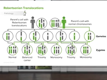 Trisomy 13 & 18 - Pediatric Genetics