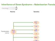 Trisomy 21 (Down Syndrome): Introduction - Pediatrics
