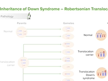Trisomy 21 - Pediatric Genetics
