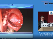 Trucs et astuces pour réussir une DCRS externe et interne (Voie endonasale)