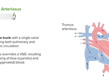 Truncus Arteriosus and TGV: Pathology - Pediatric Cardiology