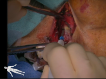 Tunneled Dialysis Catheter Removal After Inadvertent Placement in Carotid Tunneled Dialysis Catheter Removal After Inadvertent Placement in Carotid