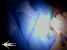 Tunneled Dialysis Catheter (TDC) Placement Tunneled Dialysis Catheter (TDC) Placement