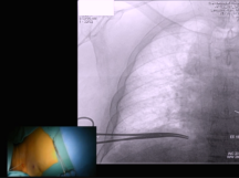 Tunneled Dialysis Catheter Tunneled Dialysis Catheter