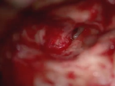 Tympanoplasty for tympanic membrane retraction