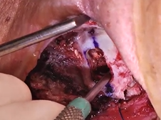 Type 1 thyroplasty with arytenoid adduction