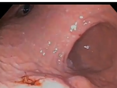 Type II Peptic Ulcer
