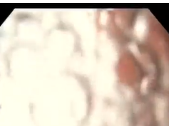 Type III Hiatal Hernia