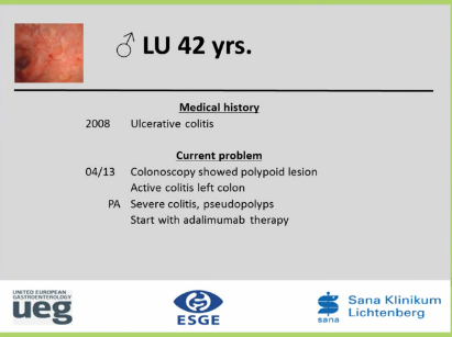 UEG Week 2013 - Chromoendoscopy in colitis UEG Week 2013 - Chromoendoscopy in colitis