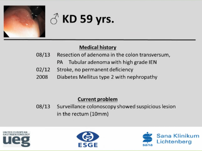 UEG Week 2013 - Colonoscopy and ESD of rectal lesion UEG Week 2013 - Colonoscopy and ESD of rectal lesion