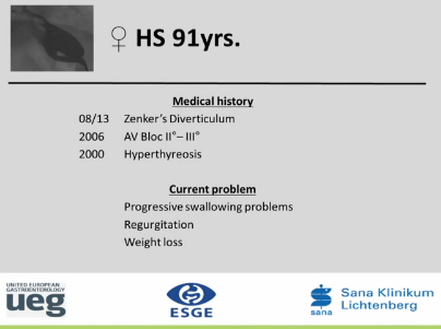 UEG Week 2013 - Diverticulotomy of Zenkers diverticulum UEG Week 2013 - Diverticulotomy of Zenkers diverticulum
