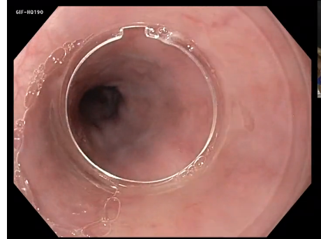 UEG Week 2013 - EMR of early Barrett's cancer UEG Week 2013 - EMR of early Barrett's cancer