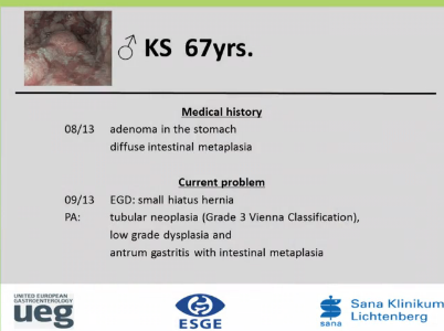 UEG Week 2013 - ESD of gastric adenoma UEG Week 2013 - ESD of gastric adenoma