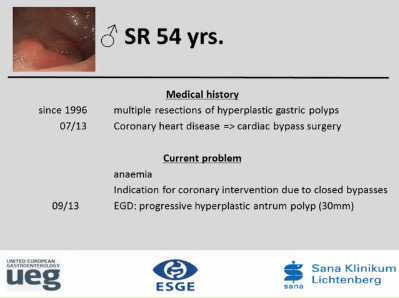 UEG Week 2013 - ESD of gastric lesion UEG Week 2013 - ESD of gastric lesion