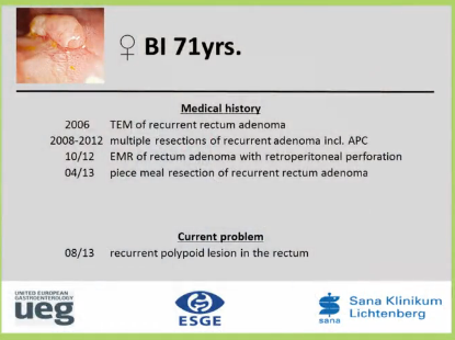 UEG Week 2013 - ESD of rectal lesion UEG Week 2013 - ESD of rectal lesion