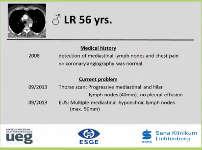 UEG Week 2013 - EUS FNA of mediastinal lymph node UEG Week 2013 - EUS FNA of mediastinal lymph node