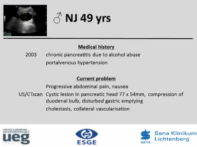UEG Week 2013 - EUS guided cystgastrostomy with metal stent UEG Week 2013 - EUS guided cystgastrostomy with metal stent
