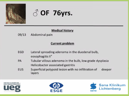 UEG Week 2013 - Laterally spreading adenoma in duodenal bulb UEG Week 2013 - Laterally spreading adenoma in duodenal bulb