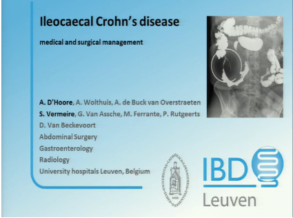 UEG Week 2013 - Management of ileocaecal Crohn's disease. Today and tomorrow UEG Week 2013 - Management of ileocaecal Crohn's disease. Today and tomorrow