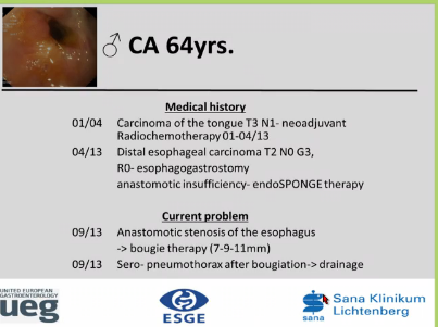 UEG Week 2013 - Oesophageal stent for anastamotic oesophageal stricture UEG Week 2013 - Oesophageal stent for anastamotic oesophageal stricture