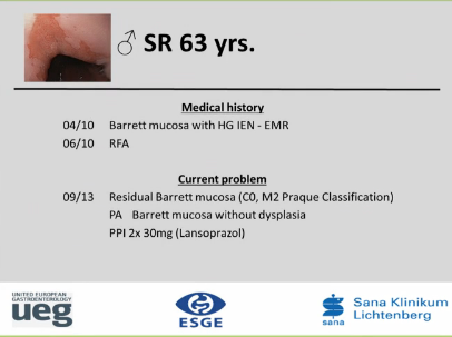 UEG Week 2013 - RFA of short segment Barratt's UEG Week 2013 - RFA of short segment Barratt's