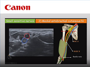 Ultrasound approach of small cervical and peripheral nerves: from normal to pathology Ultrasound approach of small cervical and peripheral nerves: from normal to pathology