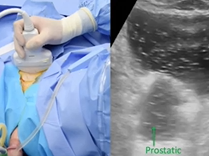 Ultrasound-guided morcellation during difficult HoLEP