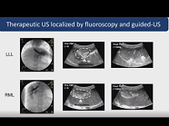 Ultrasound Mediated Gene Delivery in Large Animal Models Ultrasound Mediated Gene Delivery in Large Animal Models
