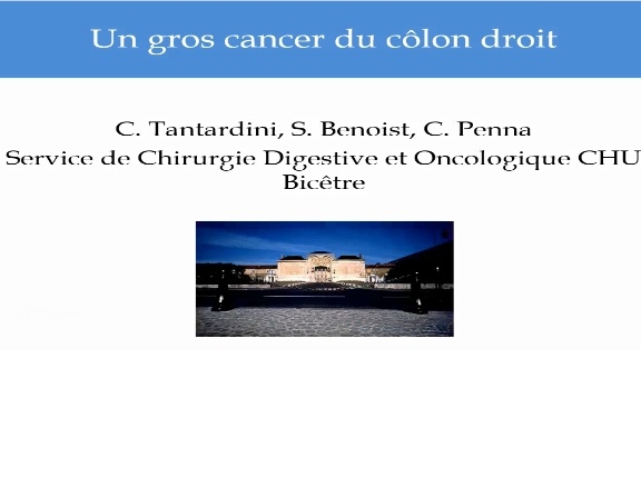 Un gros cancer du côlon droit