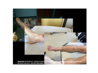 Une nouvelle anatomie application aux les lambeaux fins Une nouvelle anatomie application aux les lambeaux fins