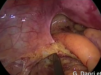 Up-to-Down Rectal Resection with Total Mesorectal Excision through Single-incision Laparoscopy Up-to-Down Rectal Resection with Total Mesorectal Excision through Single-incision Laparoscopy