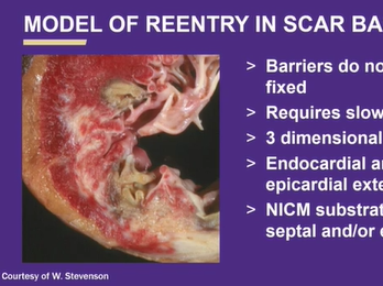 Update in the Management of Ventricular Arrhythmias: A Focus on Ablation