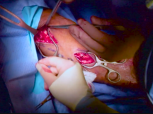 Upper Arm Single-Stage Basilic Fistula Creation Upper Arm Single-Stage Basilic Fistula Creation