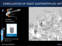 Upper GI Bleeding After Esophago-Gastrectomy Upper GI Bleeding After Esophago-Gastrectomy