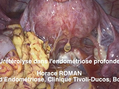 Urétérolyse dans l'endométriose profonde par Horace ROMAN - Congrès Gynazur 2019 Urétérolyse dans l'endométriose profonde par Horace ROMAN - Congrès Gynazur 2019