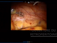 Urétérolyse et Curage Robot guidés par Fluorescence