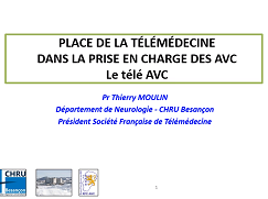 Urgences neuro-vasculaires - AVC et télémédecine : intérêts et limites