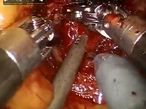 Urology Core Curriculum: Demonstration of Nerve Spring Technique During Robotic Radical Cystectomy Urology Core Curriculum: Demonstration of Nerve Spring Technique During Robotic Radical Cystectomy