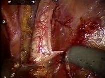 Urology Core Curriculum: Robotic Assisted Extended Lymph Node Dissection for Pelvic Malignancies Urology Core Curriculum: Robotic Assisted Extended Lymph Node Dissection for Pelvic Malignancies