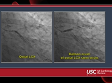 USC Discussion: STEMI & LM Bifurcation Stenting  Case 2 USC Discussion: STEMI & LM Bifurcation Stenting  Case 2