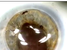 Use of a Microvascular Clip for Iris Fixation of an Intraocular Lens: A Laboratory Model Use of a Microvascular Clip for Iris Fixation of an Intraocular Lens: A Laboratory Model