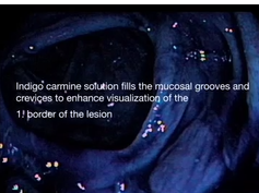 Use of Indigo Carmine Solution in Endoscopic Identification and Resection of Nonpolypoid Colorectal Use of Indigo Carmine Solution in Endoscopic Identification and Resection of Nonpolypoid Colorectal