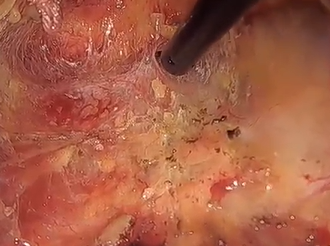 Use of Indocyanine Green to Identify the Transanal Dissection Plane in Abdominoperineal Resection Use of Indocyanine Green to Identify the Transanal Dissection Plane in Abdominoperineal Resection