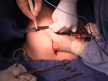 Use of Negative Pressure Dressings over Closed Incisions to Prevent SSI in Multioperative Patients Use of Negative Pressure Dressings over Closed Incisions to Prevent SSI in Multioperative Patients