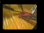 Use of radial artery for coronary revascularization