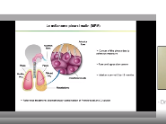 Utilisation du virus de la rougeole comme virus oncolytique