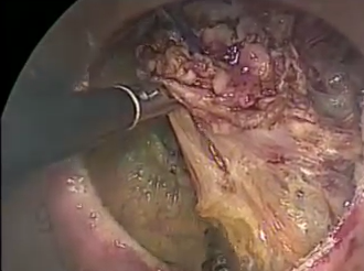 Utility Of Peritumoral ICG Fluorescence Injection During Transanal Total Mesorectal Excision Utility Of Peritumoral ICG Fluorescence Injection During Transanal Total Mesorectal Excision
