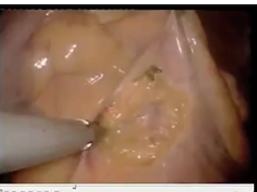 V035: Hester Cheung, MD V035: Hester Cheung, MD