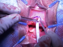 Vaginal Free Graft Dorsal Onlay Urethroplasty