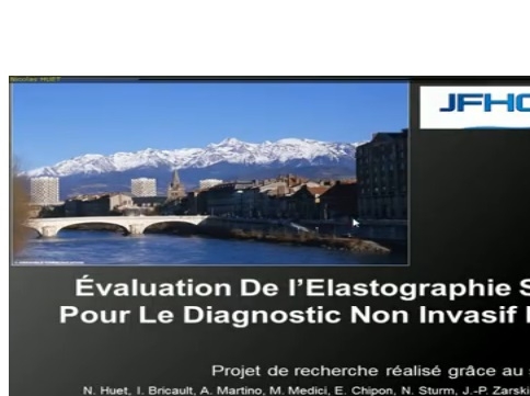 Évaluation de l’élastographie ShearWave pour le diagnostic non invasif de fibrose hépatique Évaluation de l’élastographie ShearWave pour le diagnostic non invasif de fibrose hépatique